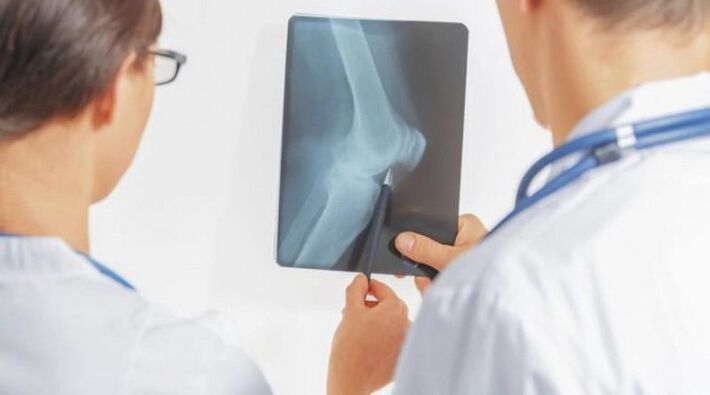 After the necessary diagnosis of arthrosis of the knee joint, the doctor prescribes a complex treatment