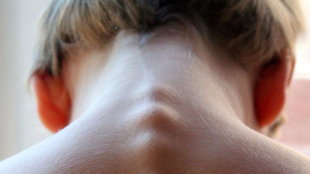 vertebrae