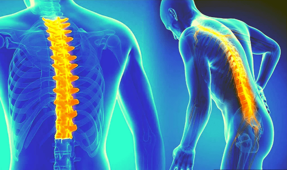 Spinal osteochondrosis