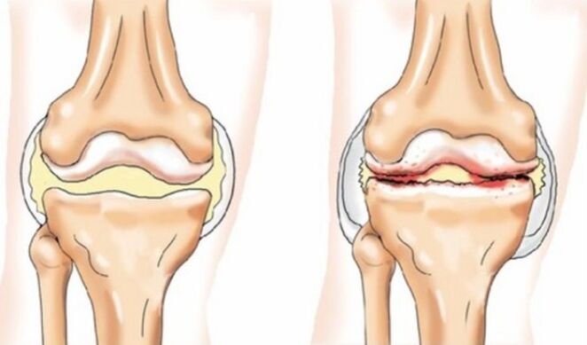 Difference in arthritis and arthrosis