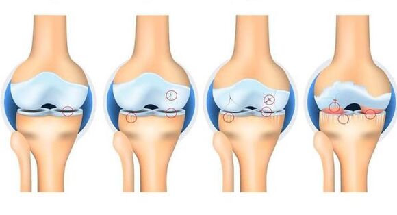 Stage of osteortrosis