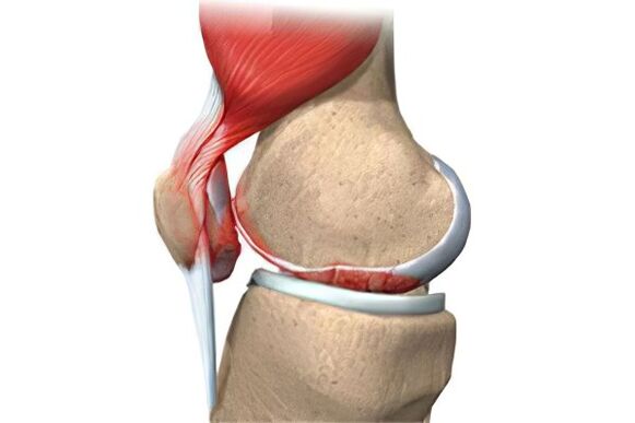 The complication of arthrosis