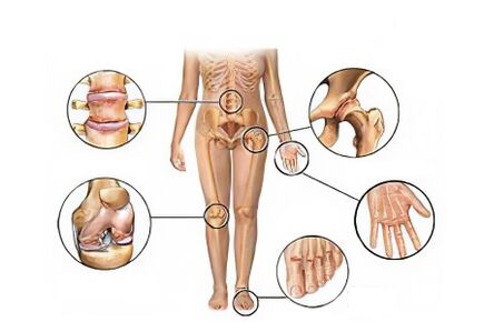 Type of arthrosis