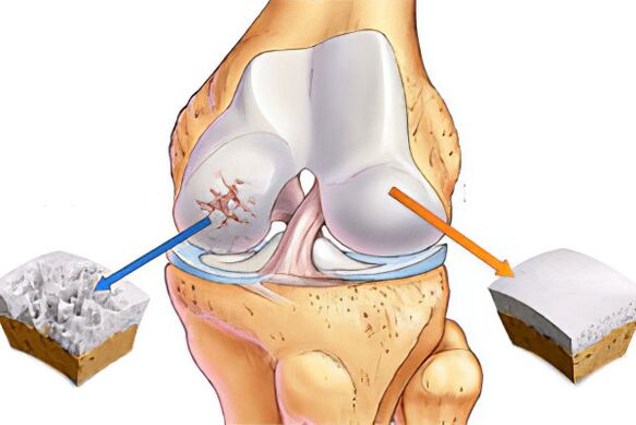 What is arthrosis