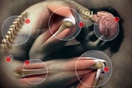 Arthrosis