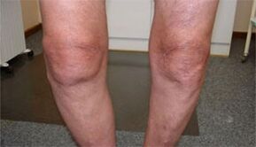 Arthritis symptoms