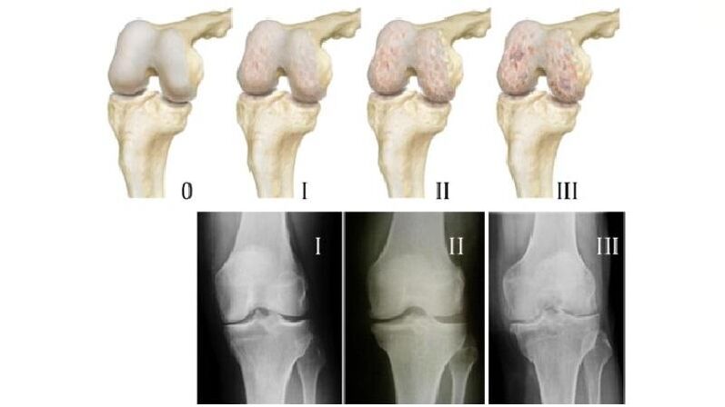 Stage of knee joint arthrosis on x-ray