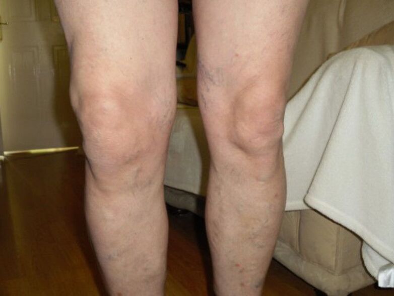 healthy knees and knee joint arthrosis