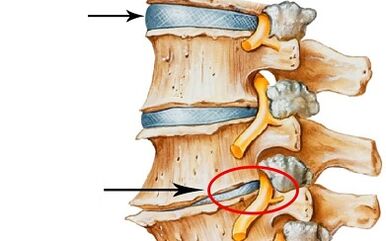 stages of development of cervical osteochondrosis