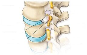 The main symptoms of cervical osteochondrosis