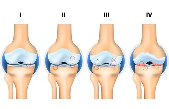 The stage of development of osteoarthritis