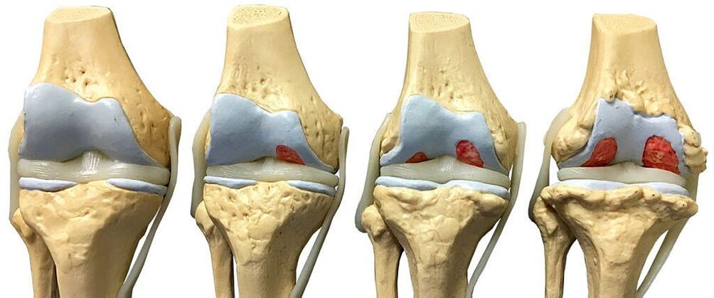 Stages of arthrosis of the knee joint